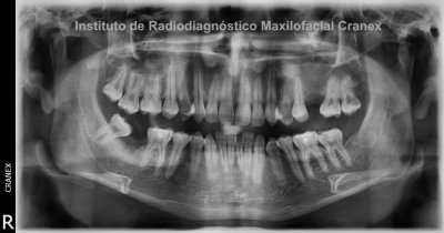 Fig. 1. Radiografía Panorámica.