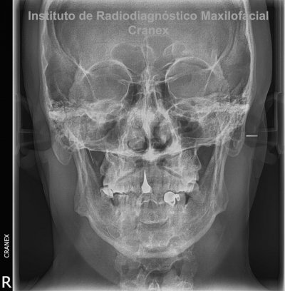 Fig. 2. Radiografía Frontal (Posteroanterior).