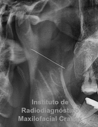 Fig. 2. Radiografía Panorámica (Close up).