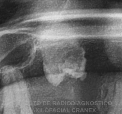 Fig. 2. Radiografía Panorámica (Close up - pieza 1.4)